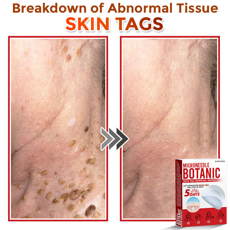 LOVILDS® MicroNeedle Botanic Skin Tag Removal Patch 🇺🇸 Made in the USA