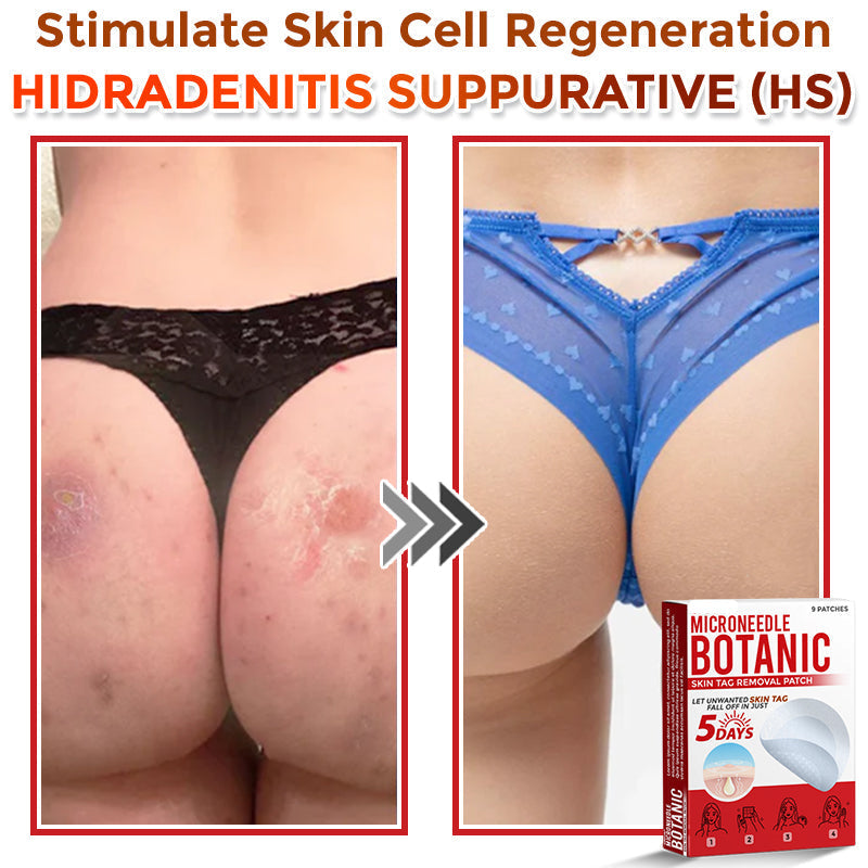 LOVILDS® MicroNeedle Botanic Skin Tag Removal Patch 🇺🇸 Made in the USA