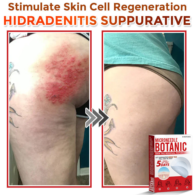 LOVILDS® MicroNeedle Botanic Skin Tag Removal Patch 🇺🇸 Made in the USA