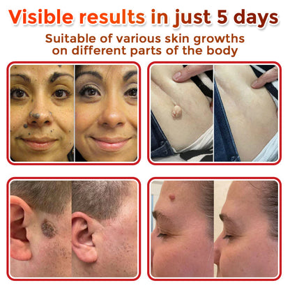 LOVILDS® MicroNeedle Botanic Skin Tag Removal Patch 🇺🇸 Made in the USA