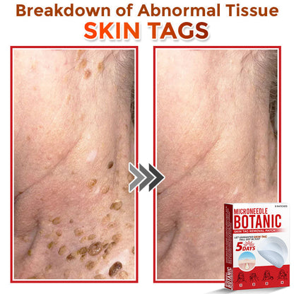 LOVILDS® MicroNeedle Botanic Skin Tag Removal Patch 🇺🇸 Made in the USA