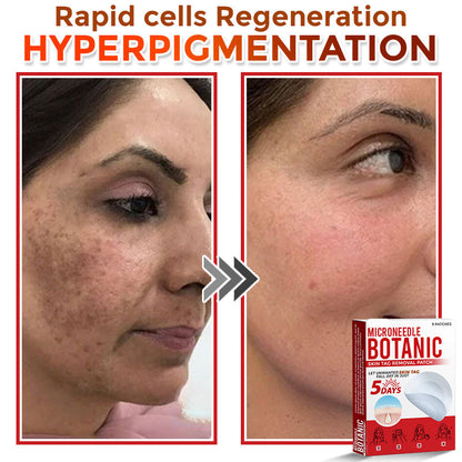 LOVILDS® MicroNeedle Botanic Skin Tag Removal Patch 🇺🇸 Made in the USA