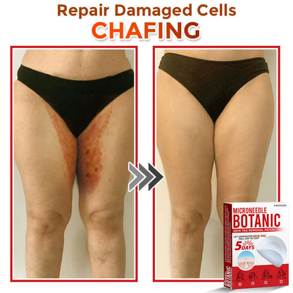 LOVILDS® MicroNeedle Botanic Skin Tag Removal Patch 🇺🇸 Made in the USA