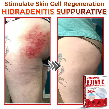 LOVILDS® MicroNeedle Botanic Skin Tag Removal Patch 🇺🇸 Made in the USA