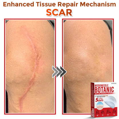 LOVILDS® MicroNeedle Botanic Skin Tag Removal Patch 🇺🇸 Made in the USA