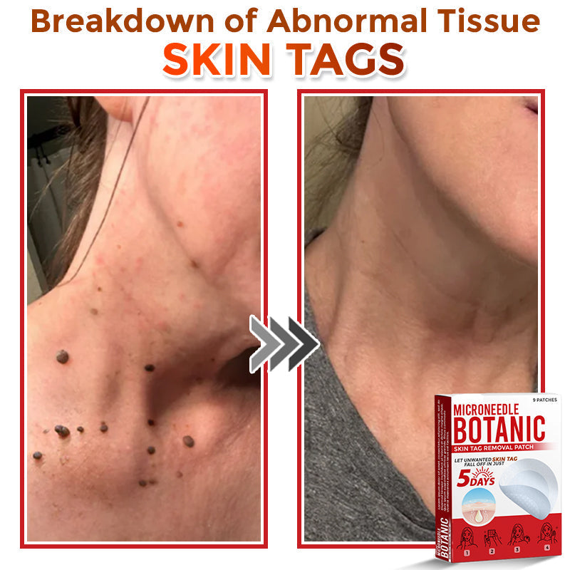 LOVILDS® MicroNeedle Botanic Skin Tag Removal Patch 🇺🇸 Made in the USA